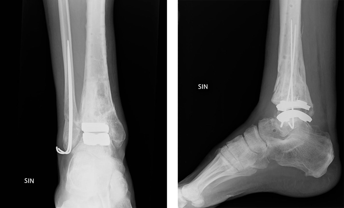 Raggi X protesi caviglia
