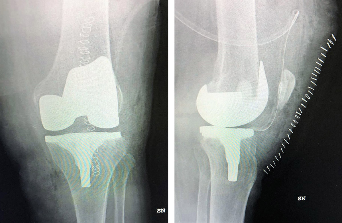 Raggi X protesi ginocchio